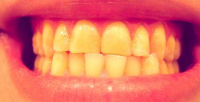 dientes con bruxismo