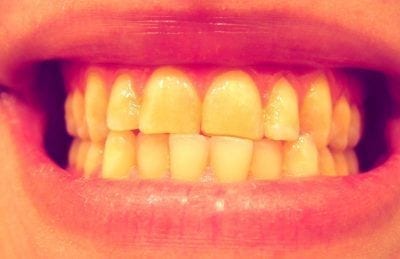 dientes con bruxismo