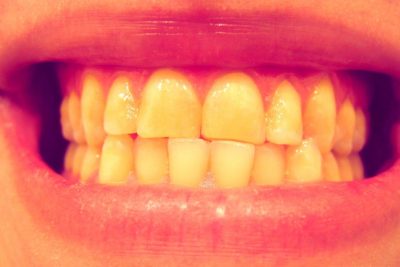 dientes con bruxismo